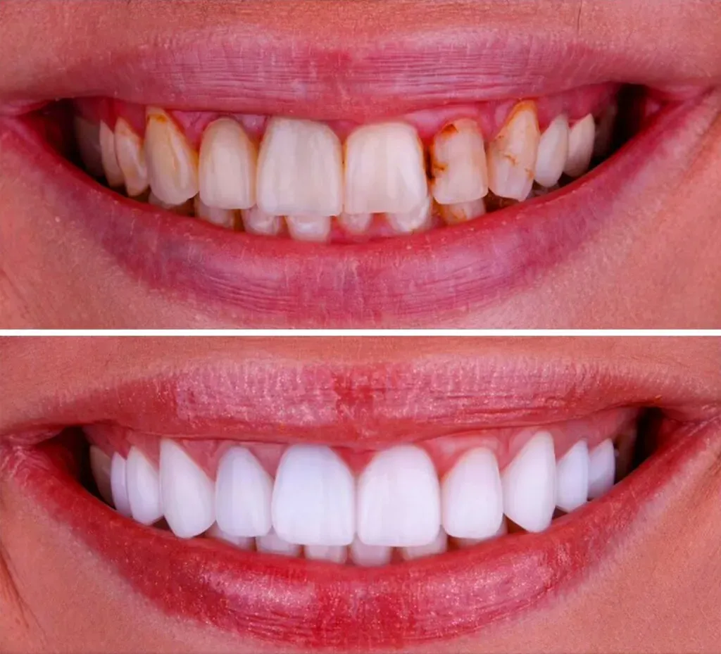 Wypełnienie kompozytowe